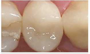 CEREC After the restoration of the effect of crown