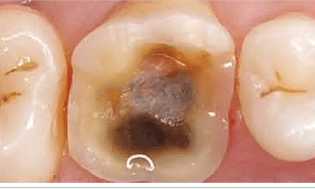 Nach dem Entfernen der Metallmaterialien in Zahn Entstehung von Sekundärkaries