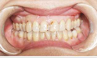 CEREC 3D瓷贴面修复前牙齿情况