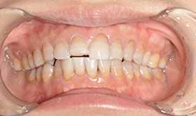 外伤牙齿缺损修复前效果
