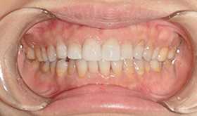外伤牙齿缺损修复后效果