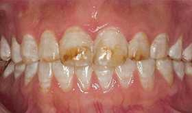 氟斑牙修复前效果